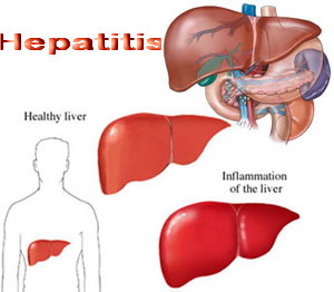 obat tradisional hepatitis